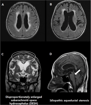 How does adult onset hydrocephalus affect the elderly?
