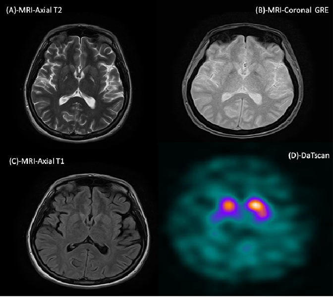 Abnormal Datscan In A Case Of Anoxic Brain Injury Mds Abstracts