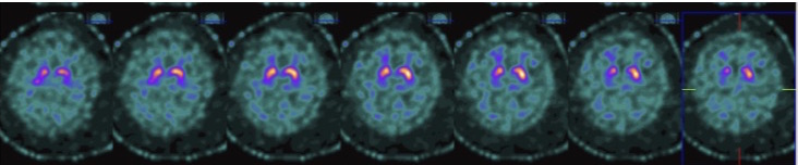 The Role of MRI and Vascular Parkinsonism: A Case - Abstracts