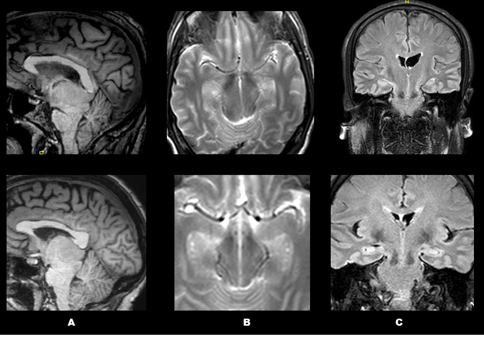 mesencephalic flexture mesencephalic flexture