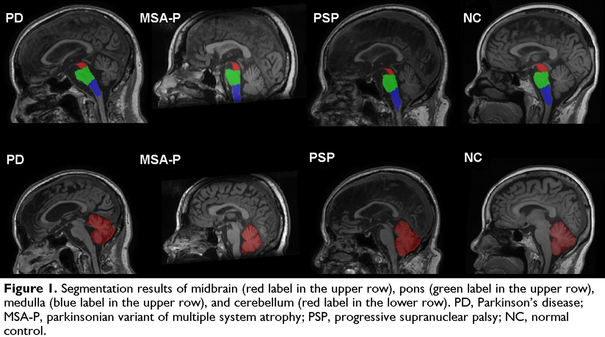 Automated Quantitative MRI in Differentiation of Progressive Supranuclear Palsy Multiple System Atrophy from Parkinson Disease - MDS Abstracts