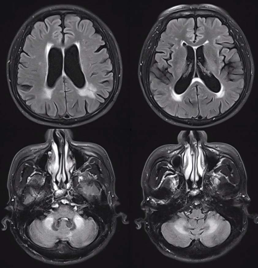 A Korean case of Fragile X-associated mild ataxia without
