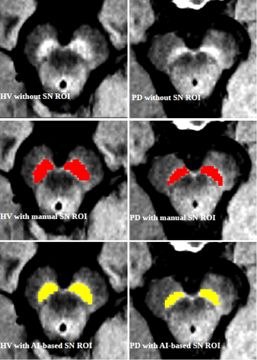 Imaging biomarkers in Parkinson's disease and Parkinsonian