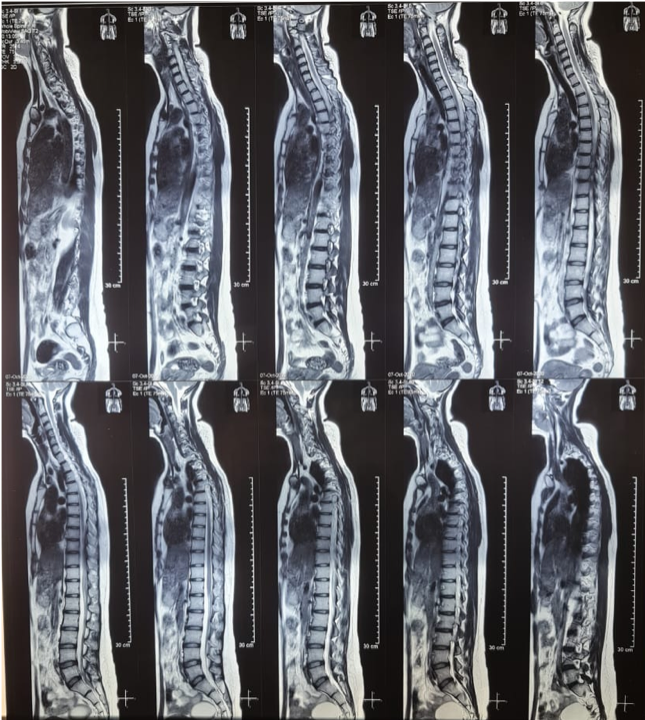 Picture 2 MRI Whole Spine