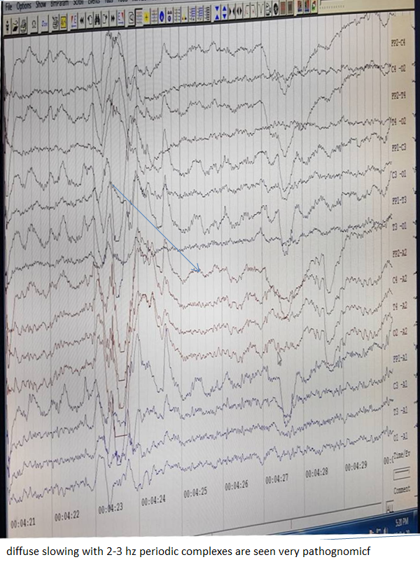 pathonomic EEG