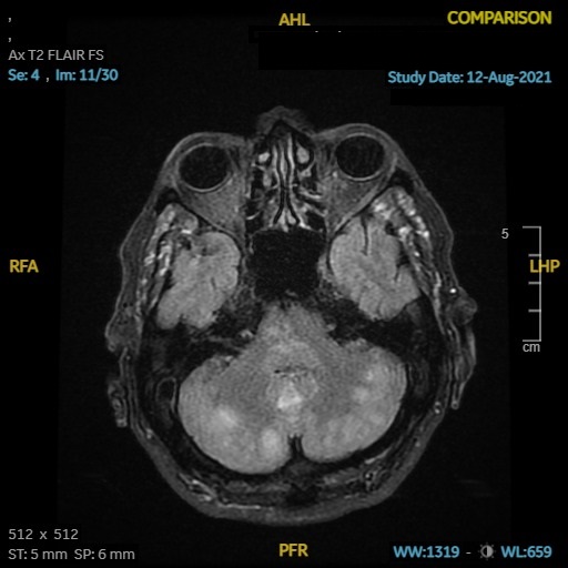 Figure 1  MR head  patchy T2 Flair both cerebellar hemispheres