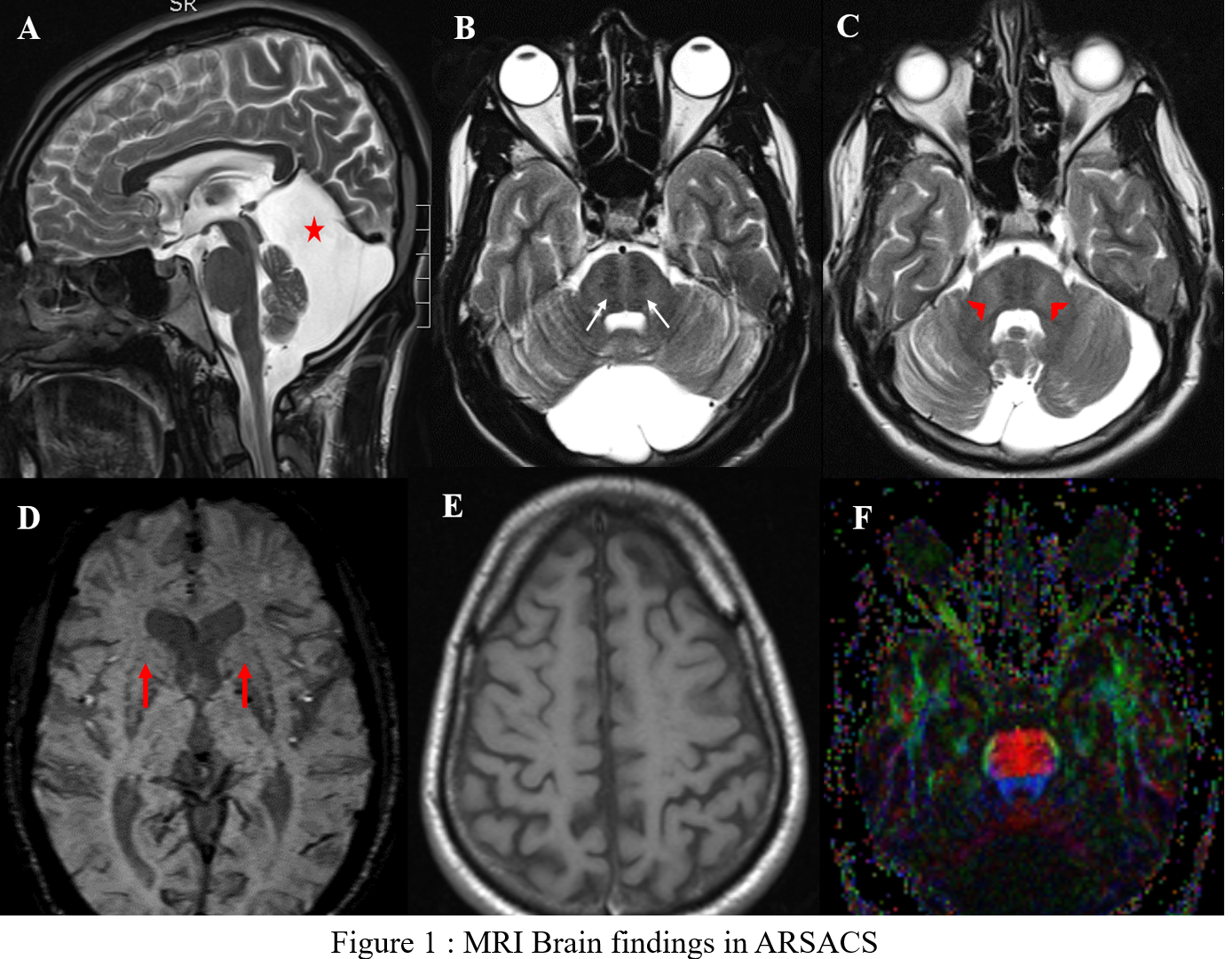 Fig 1 MRI Brain findings in ARSACS