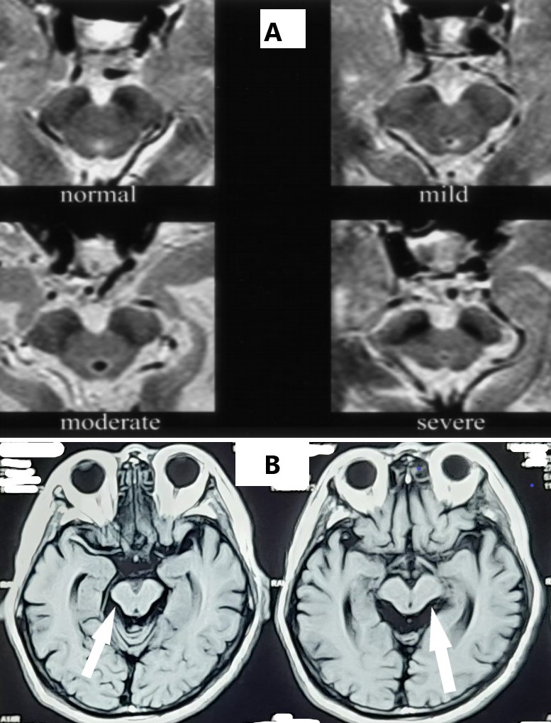 MRI axial PSP dan referensi