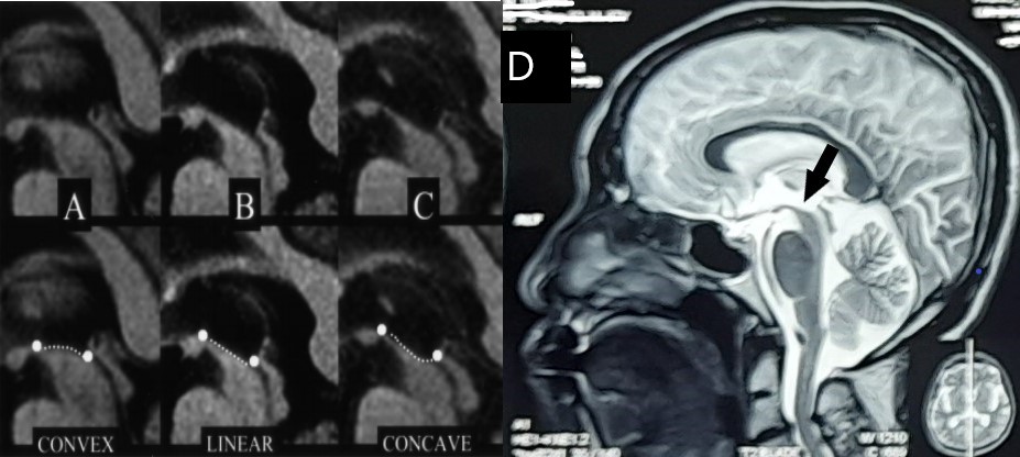 MRI sagital PSP dan referensi