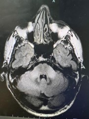 Brain MRI. FLAIR