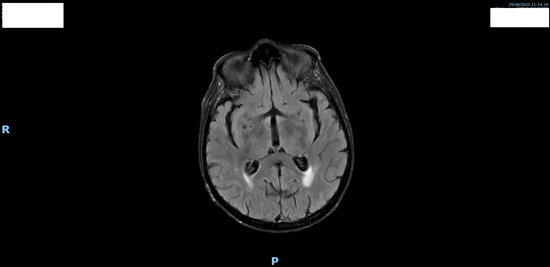 MRI Flair