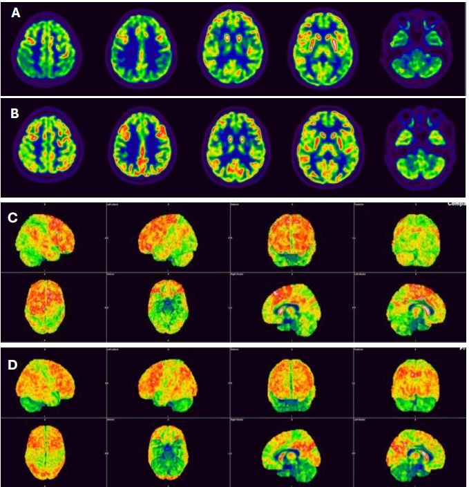 FDG-PET/CT and Syngovia quantification images.