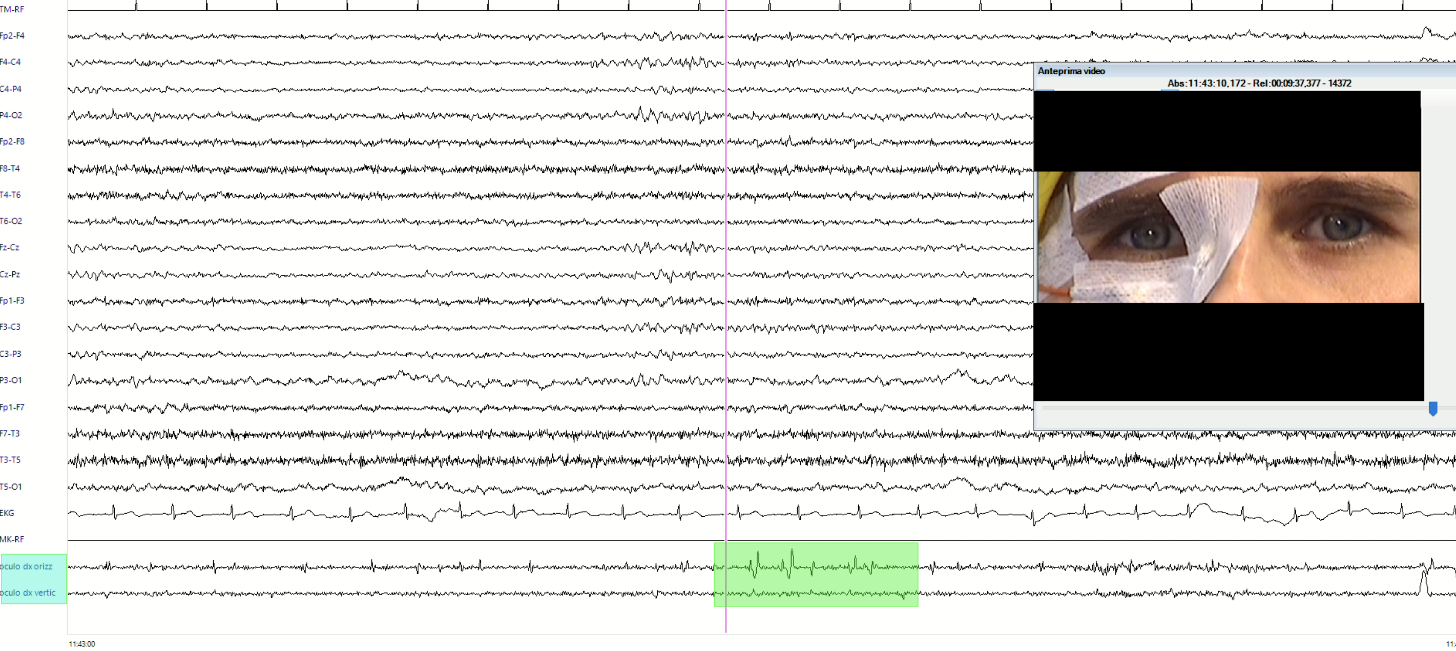 Electro-oculography (EOG) recording