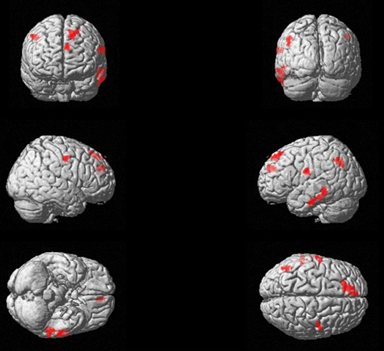 DBS-ON brain activation patterns