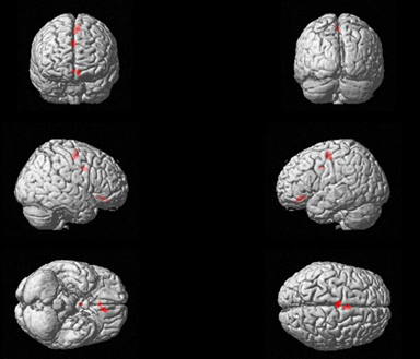 DBS-OFF brain activation patterns
