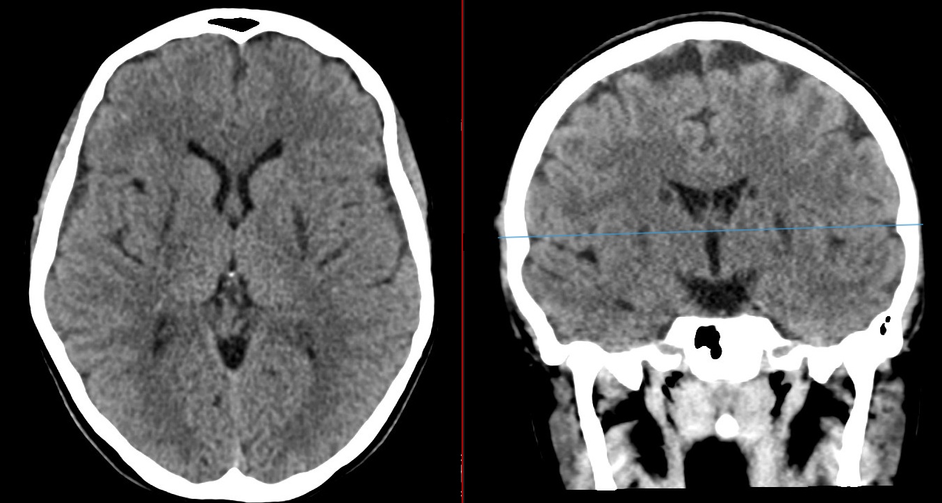 Non-contrast brain CT.