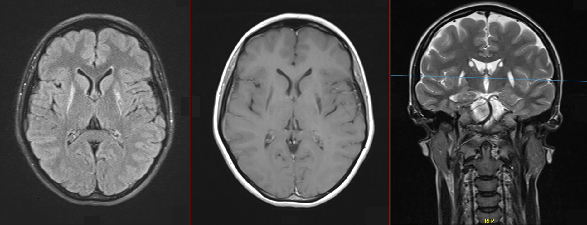 Brain MRI with gadolinium.