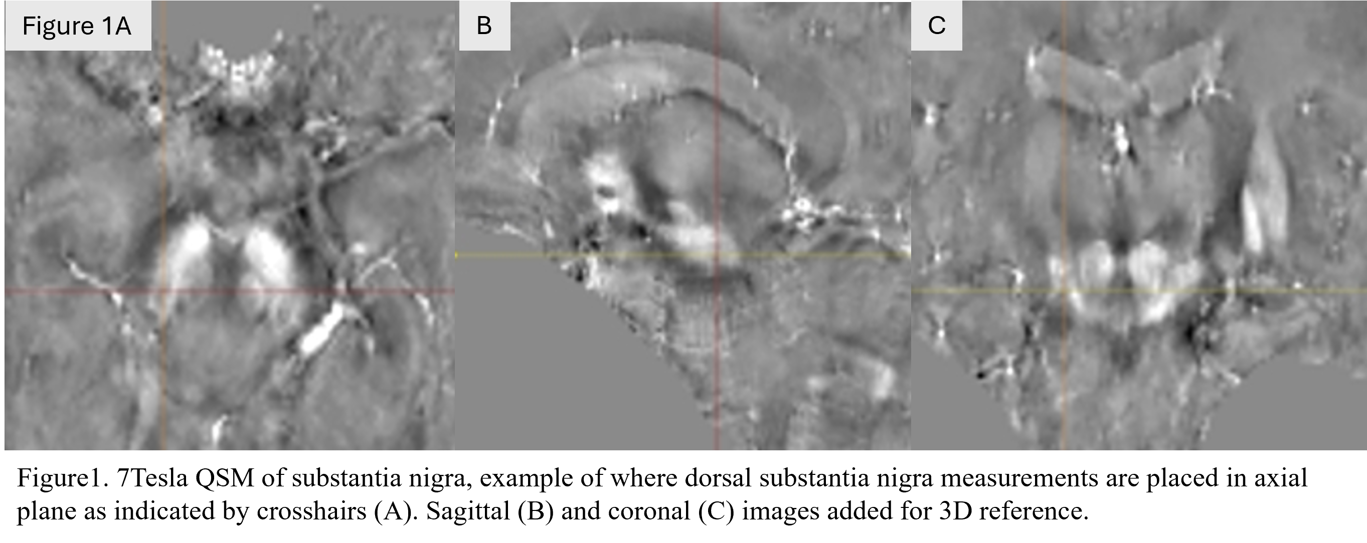 Figure 1 - 7T QSM example dSN focal ROI placement