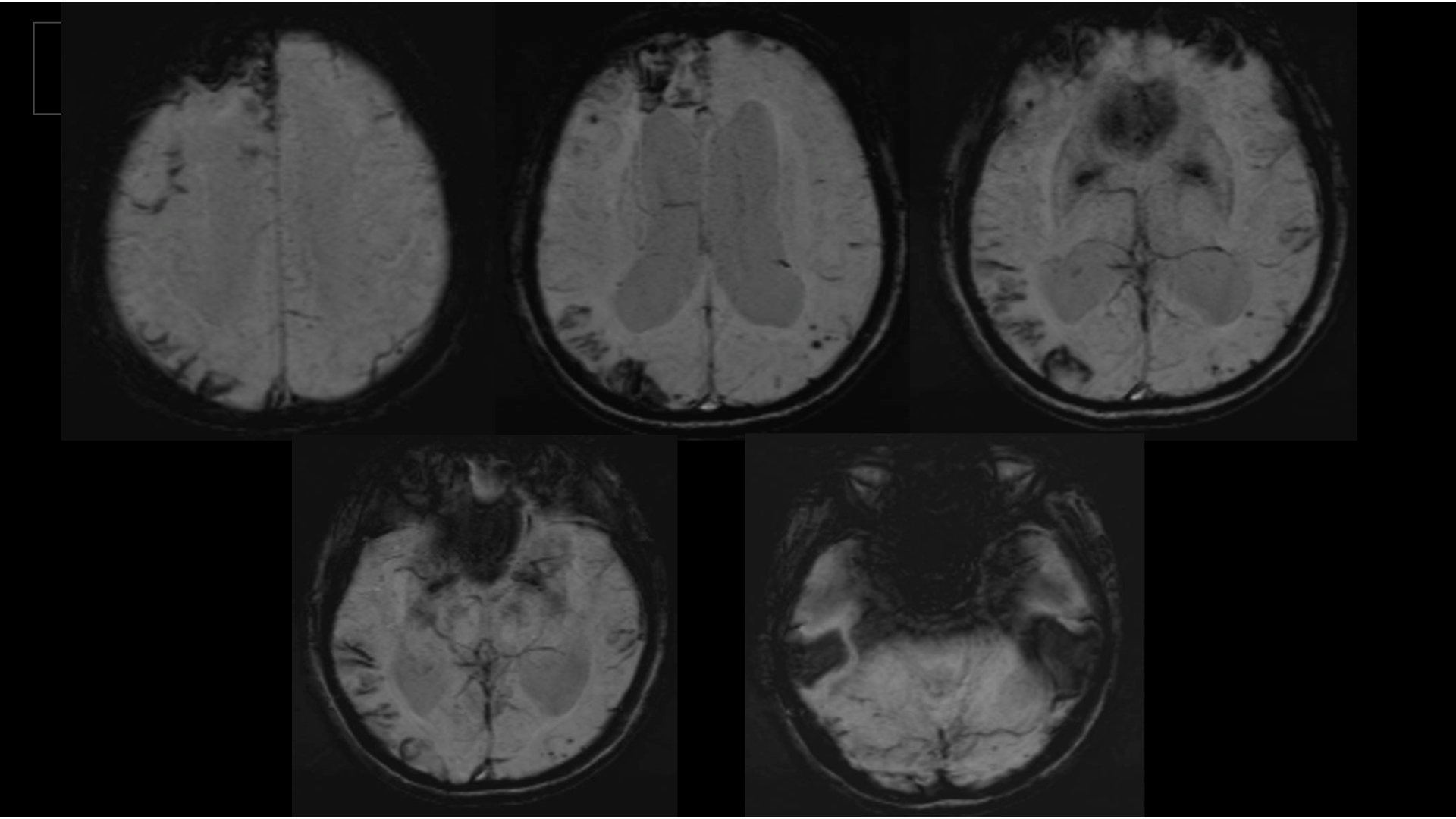 Figure 1 - Patient’s imaging Brain MRI