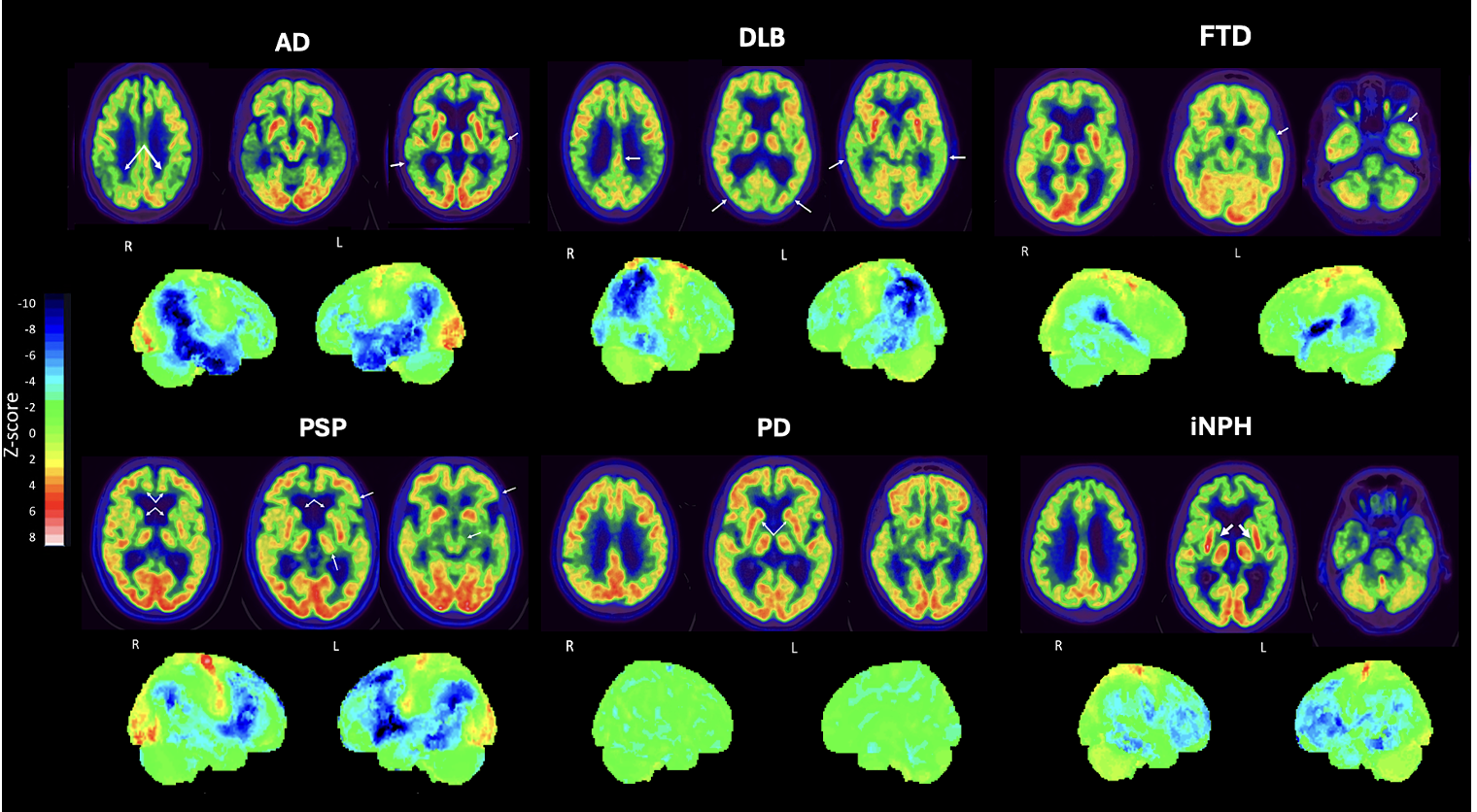 Visual FDG-PET metabolic patterns across groups