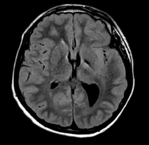 Axial T2 FLAIR MRI 36 months after symptom onset.