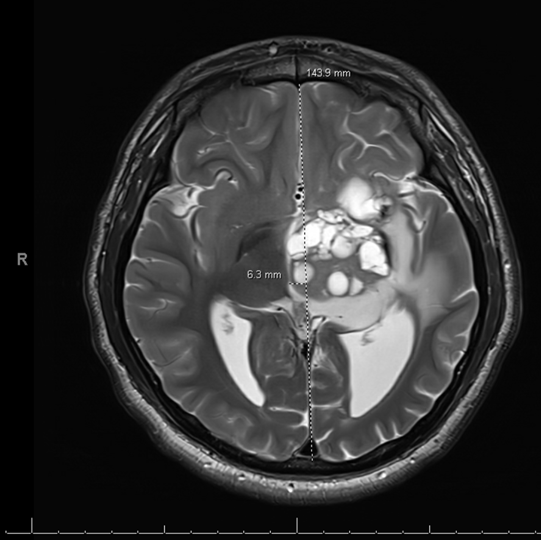Axial T2-FLAIR MRI 5 years after symptom onset.