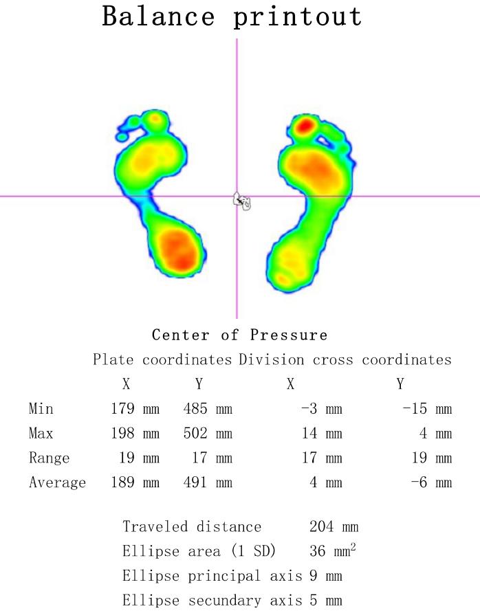 Figure 1 Sample footscan pressure image