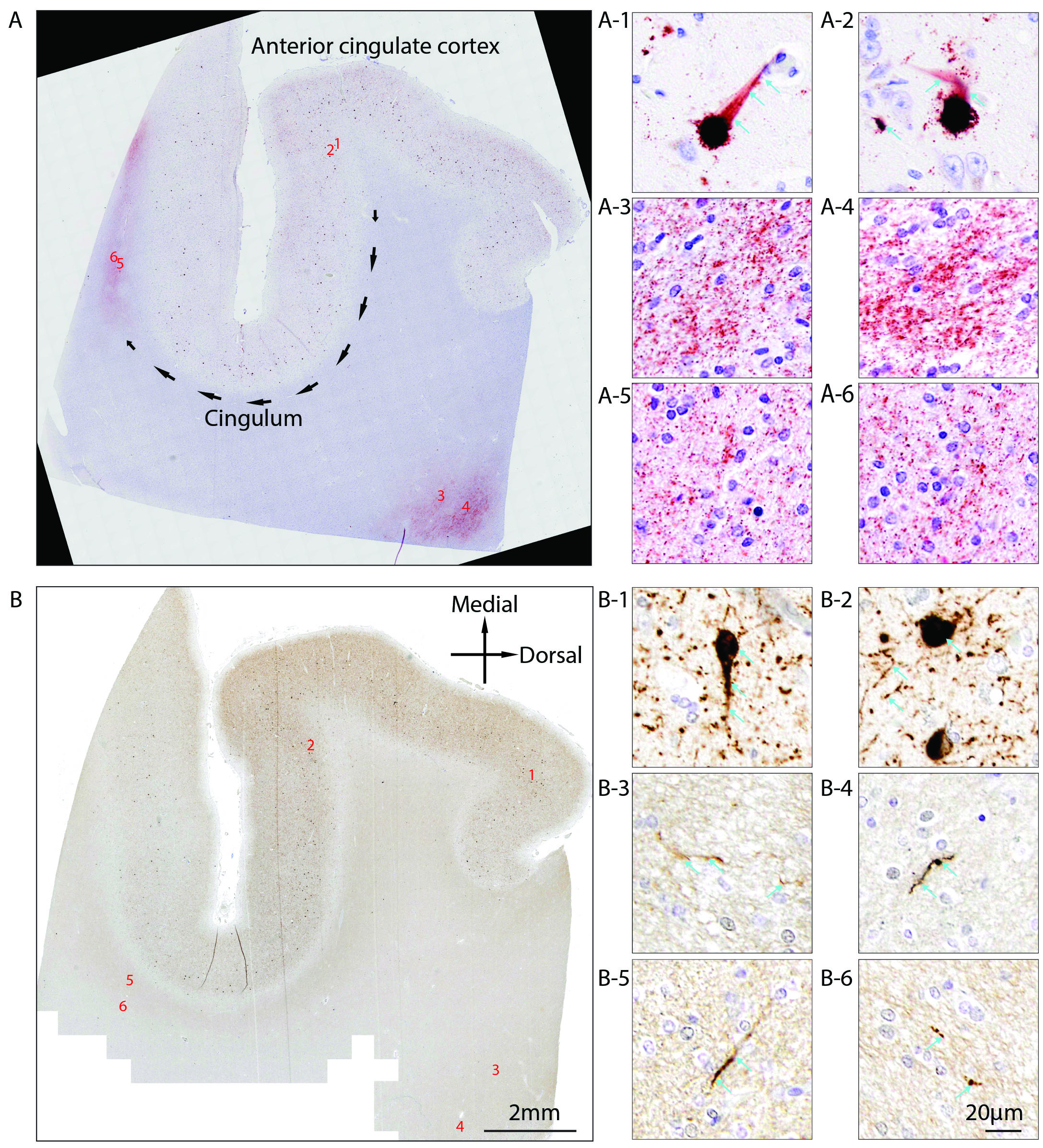 Figure 1. α-Synuclein tractopathy revealed by PLA