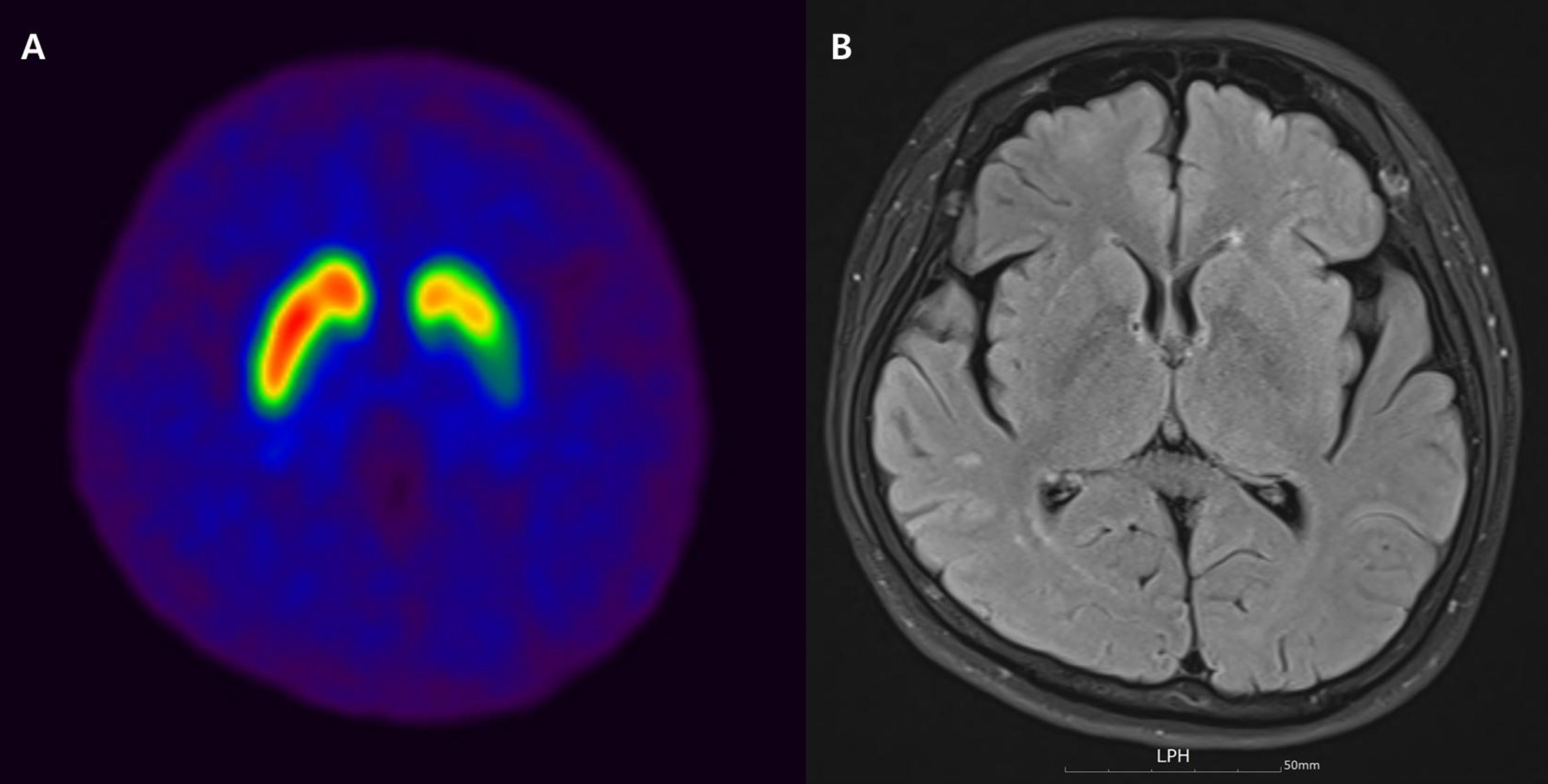 Figure 1. FP-CIT PET and T2 FLAIR images