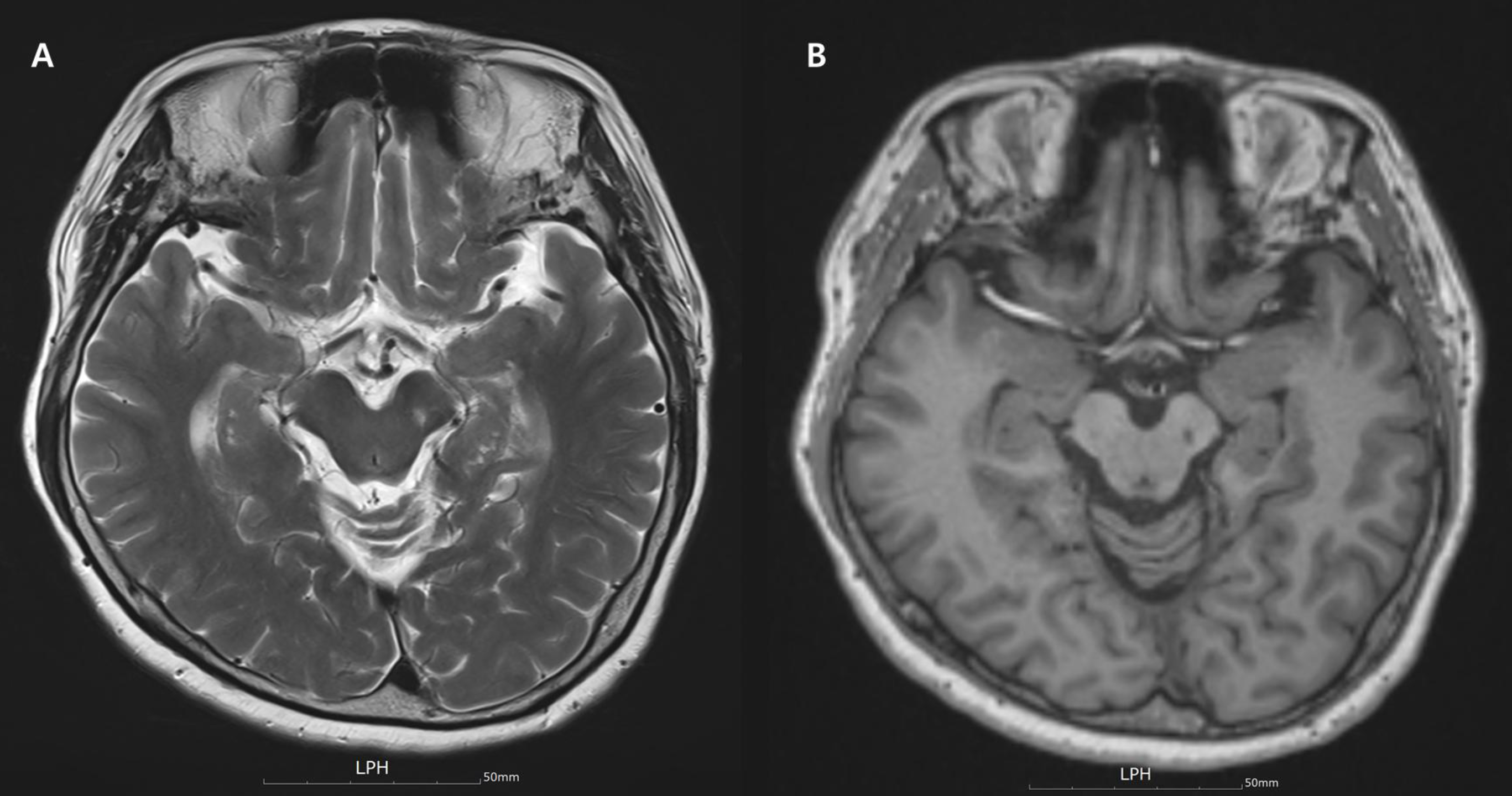 Figure 2. T2- andT1-weighted brain MRIs