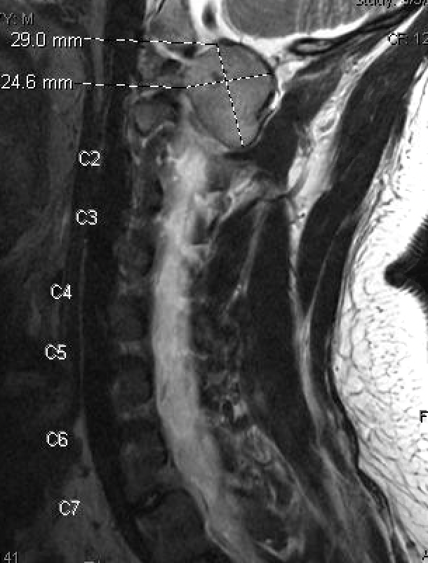 figure 1: T2 MRI cervical spine saggital