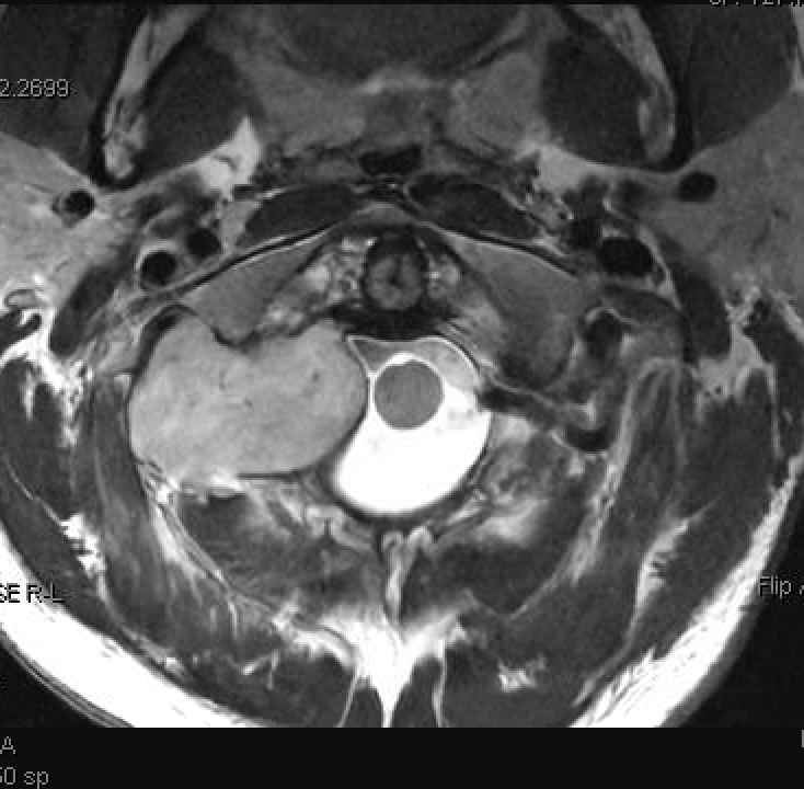 figure 2: T2 MRI cervical spine axial