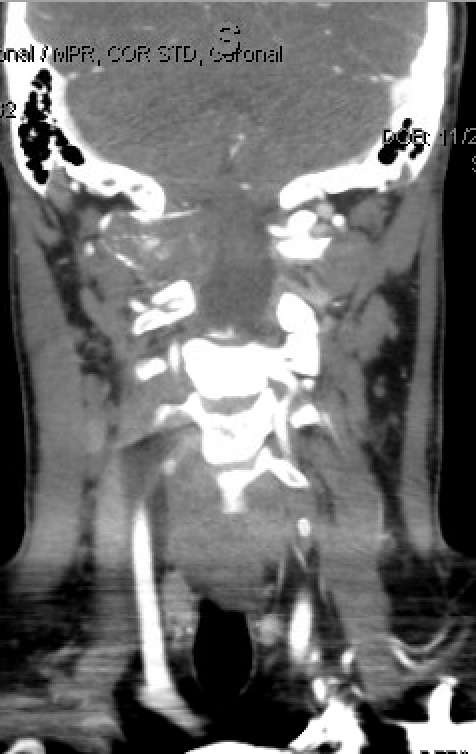 figure 3: Ct angiogram coronal