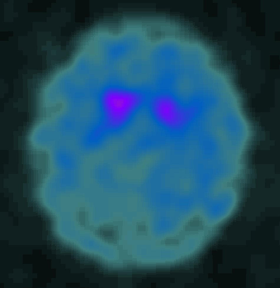 DAT scan