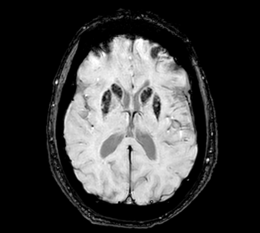 Fig 1: Image of our patient, SWI sequence at 3T.
