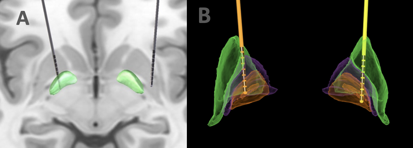 A. Lead misplacement. B. Correct GPi placement.