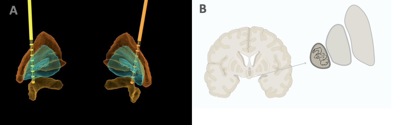A. GPi lead reconstruction. B. GPi somatotopy.