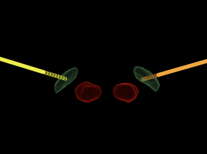 STN-DBS lead reconstruction with lateral left lead