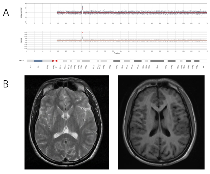 Fig 1. Proband's CNVseq and brain MRI.