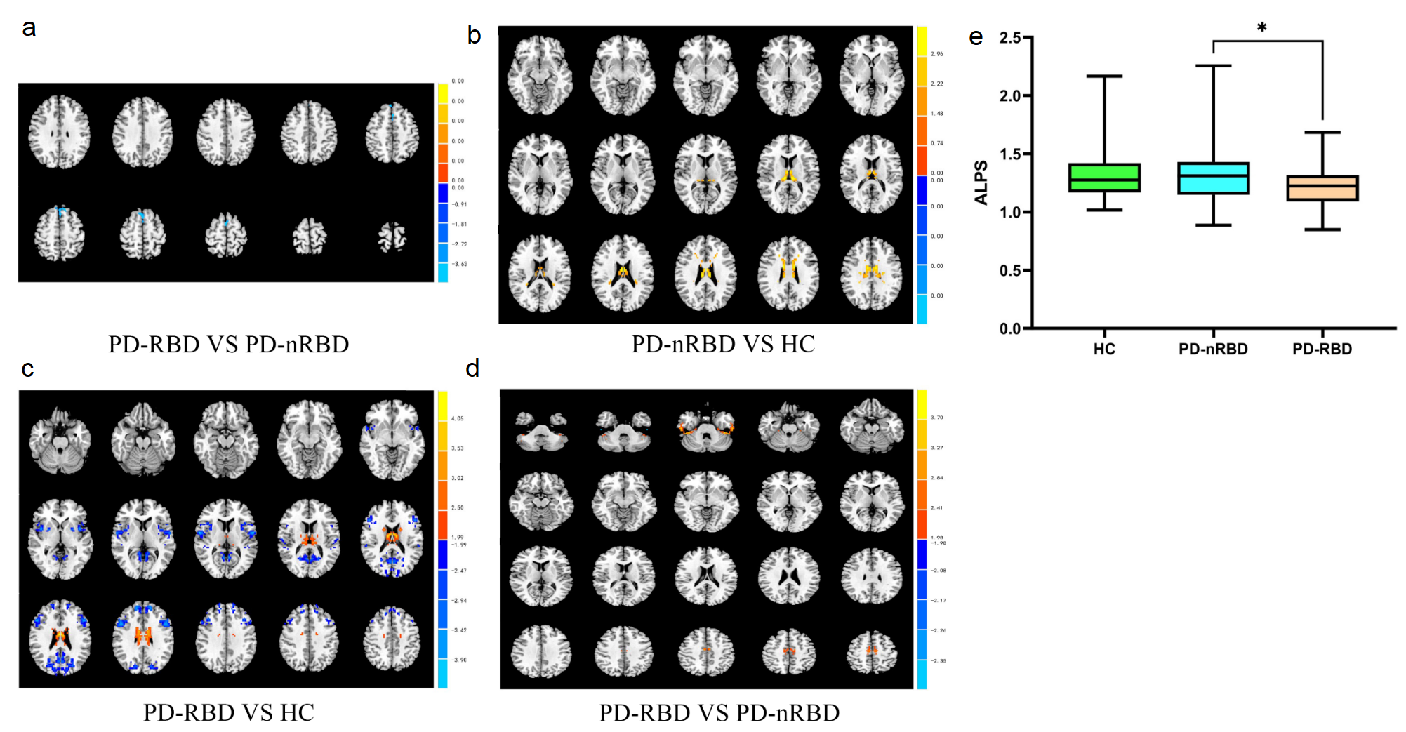 Figure 2. Brain imaging in HC, PD-RBD, PD-nRBD