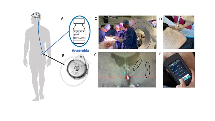 New therapeutic concept (c caudate p putamen)