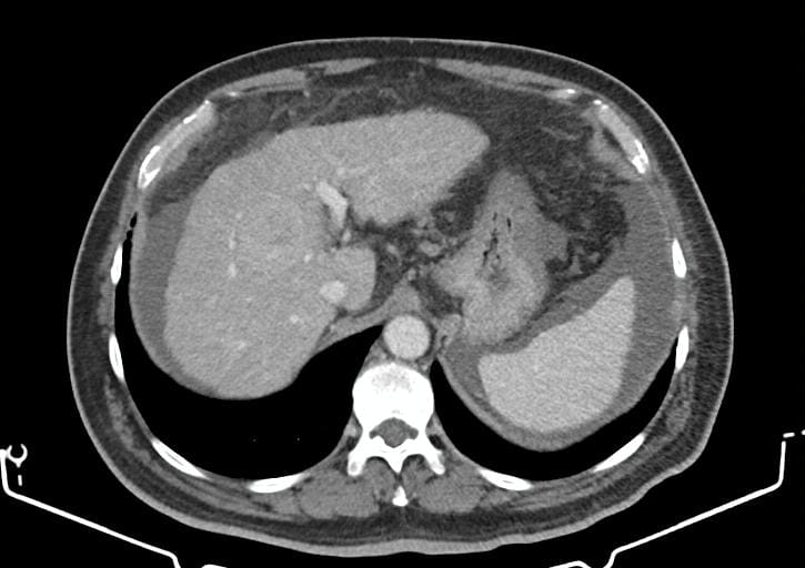 CT axial Hepatic adenocarcinoma