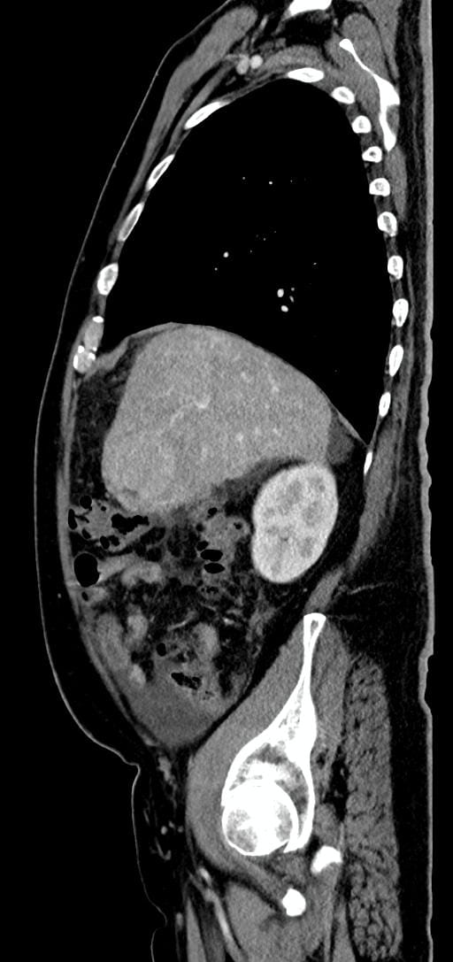 CT sagittal Hepatic adenocarcinoma