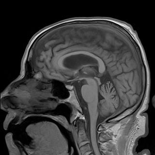 MRI sagittal Cerebellar atrophy