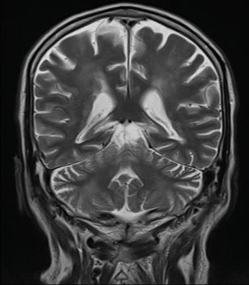 MRI coronal Cerebellar atrophy