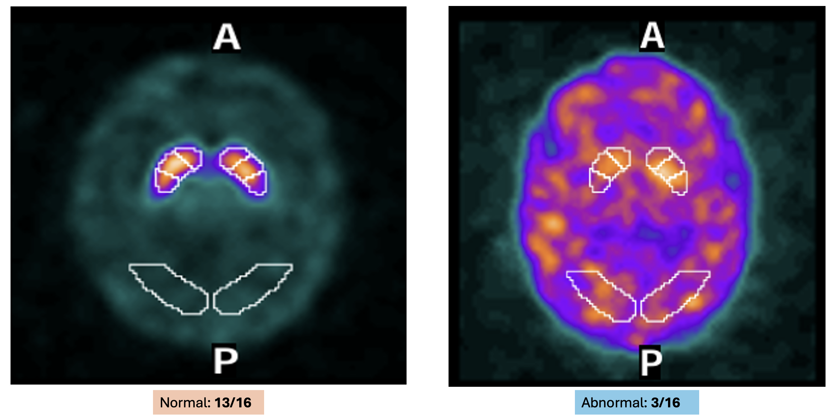 DaTscan visual results