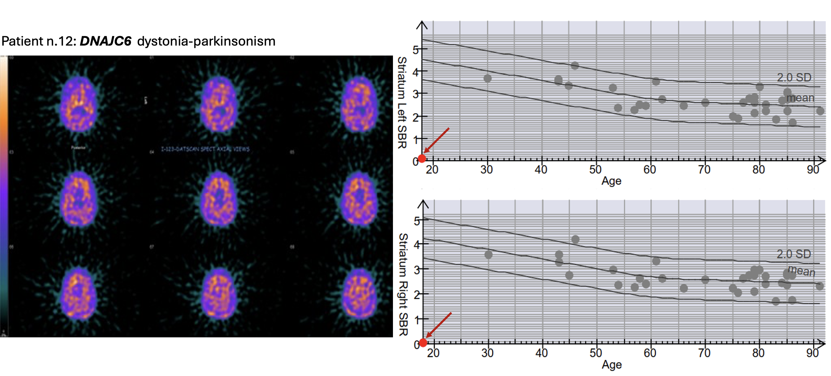 DaTscan semi-quantitative results