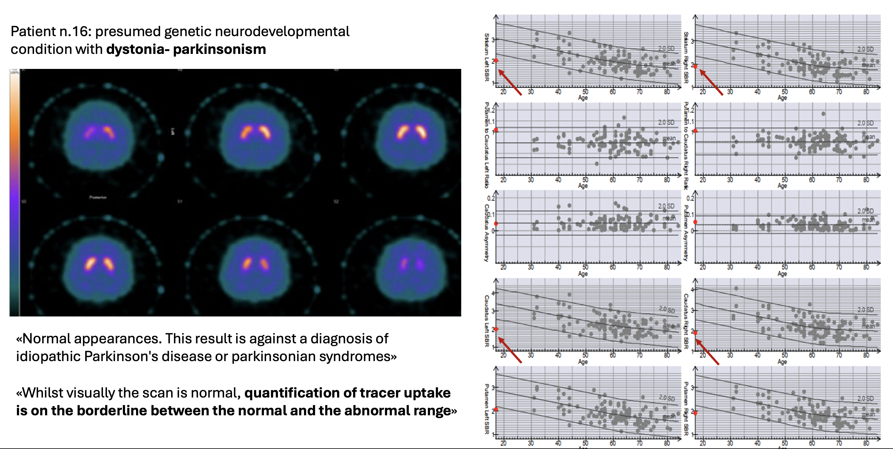 DaTscan semi-quantitative results