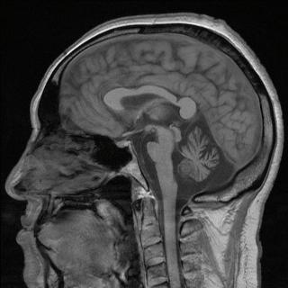 MSA MRI sagital