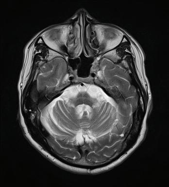 MSA MRI axial